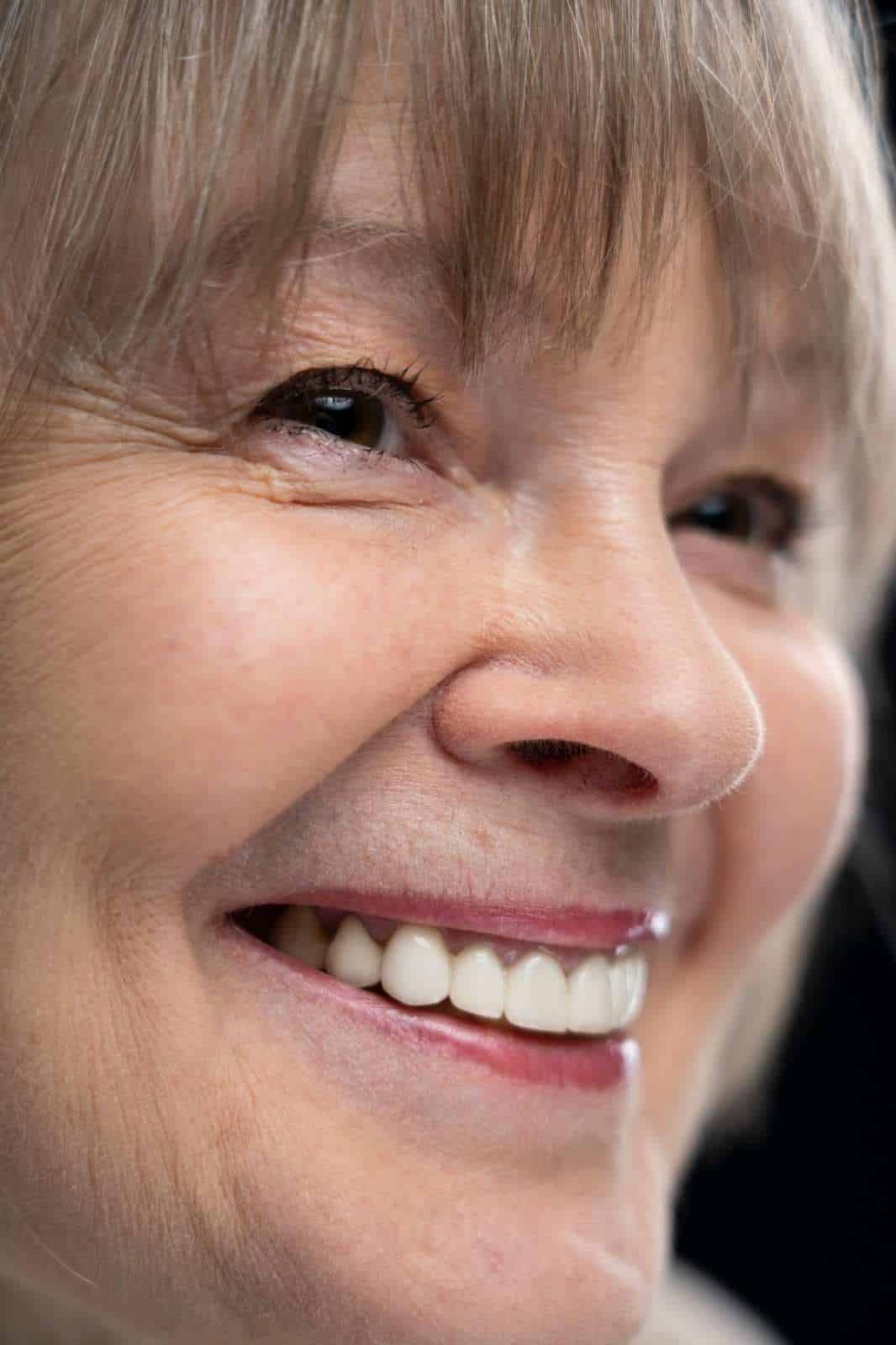 sostituzione dei denti a prezzi accessibili con ponti dentali in Albania