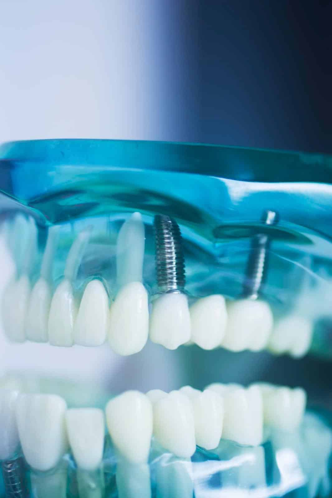 marchi di impianti certificati presso l'American Dental Hospital in Albania