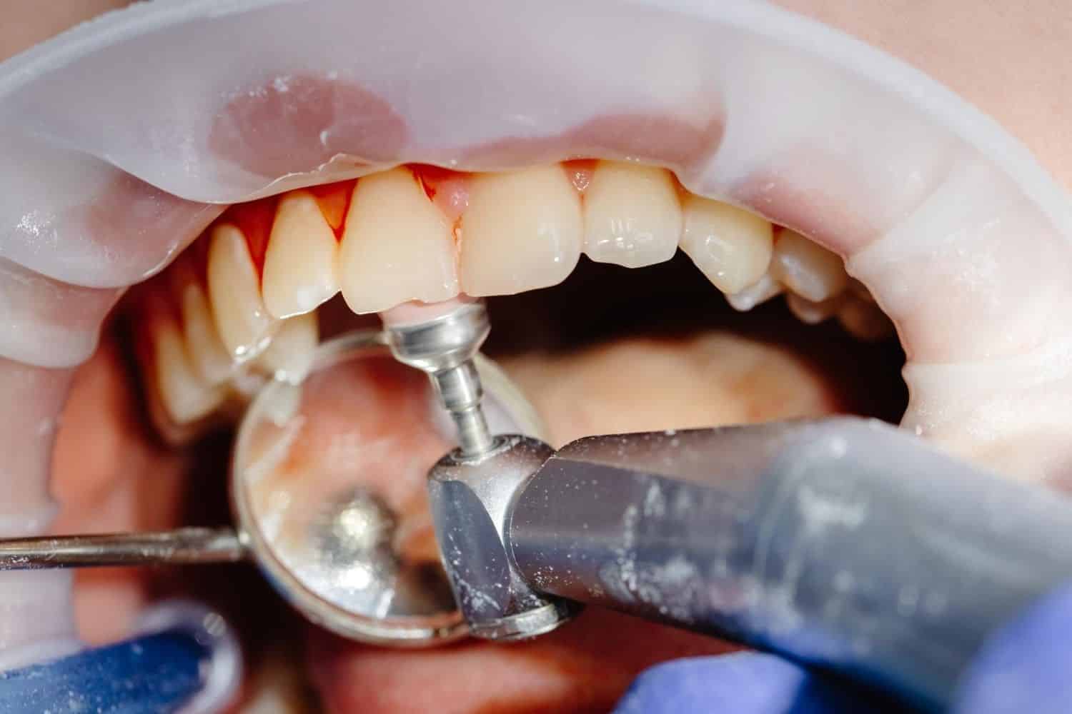 clinica dentale a prezzi accessibili in Albania