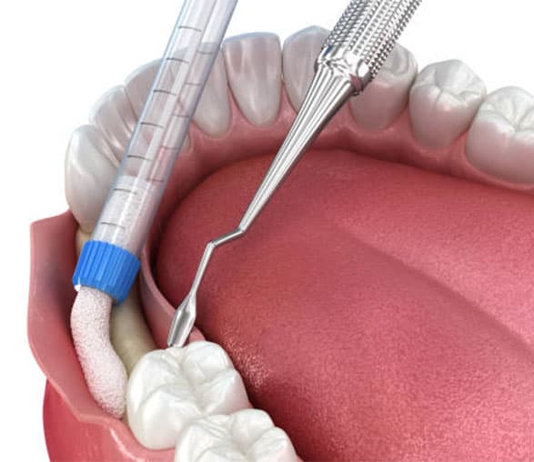 Innesto osseo in Albania per l'impianto dei denti