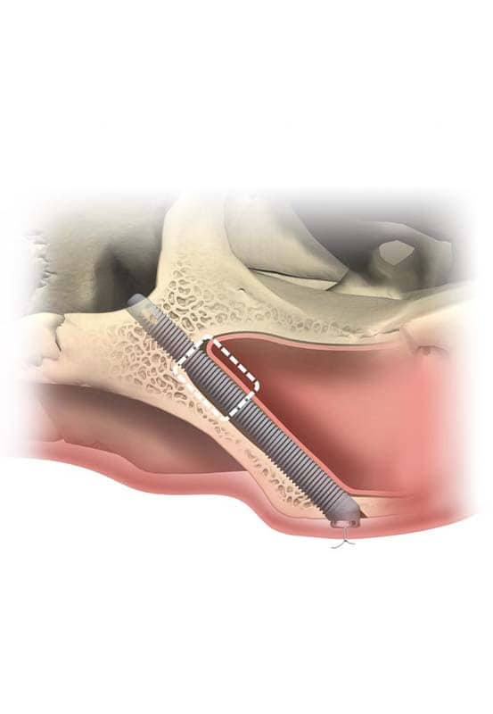 impianti zigomatici avanzati in Albania per pazienti con poco osso