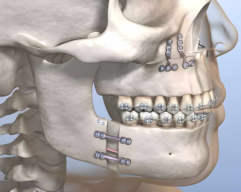 trattamenti ortognatici a prezzi accessibili in Albania