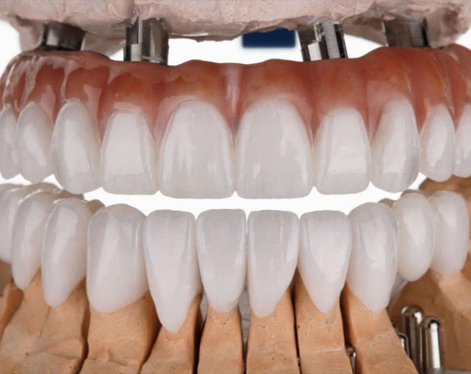 Implante të gjitha në 4 çmime të përballueshme në Shqipëri