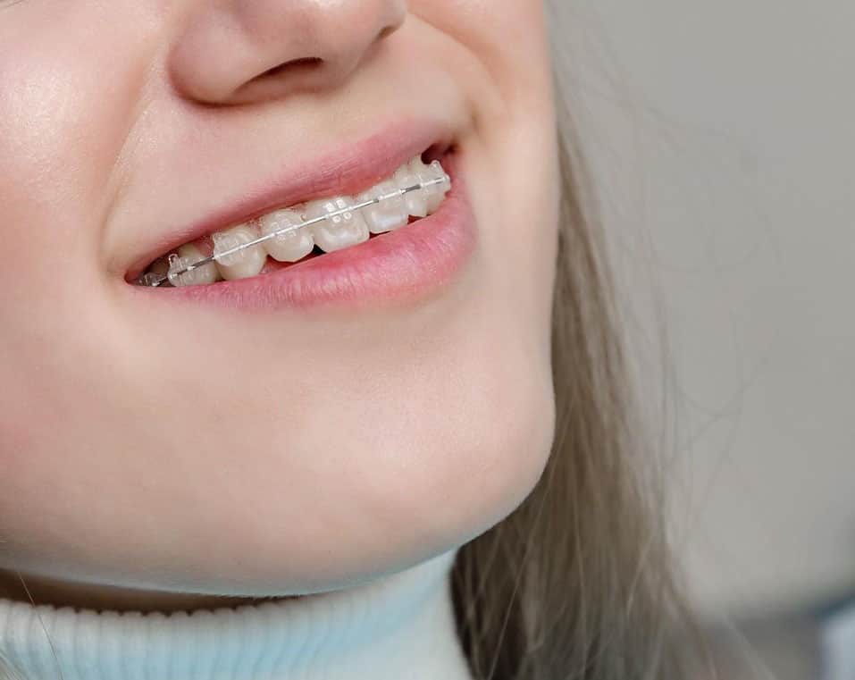 apparecchi ortodontici trasparenti a prezzi accessibili in Albania