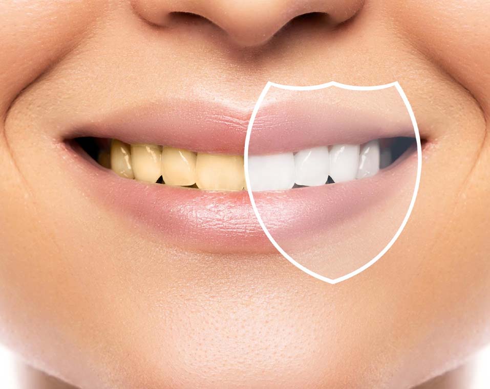 odontoiatria estetica a prezzi accessibili in Albania