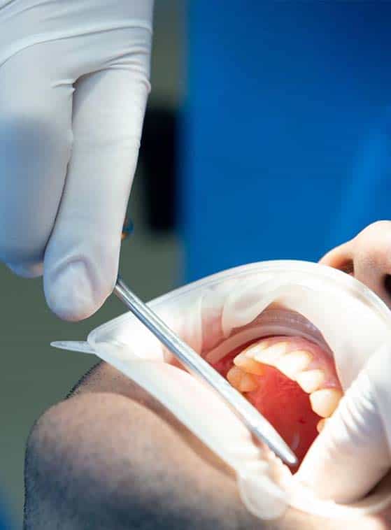 innesto osseo dentale a prezzi accessibili in Albania