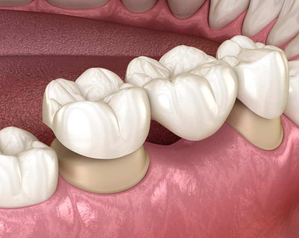 ponti dentali a prezzi accessibili in Albania