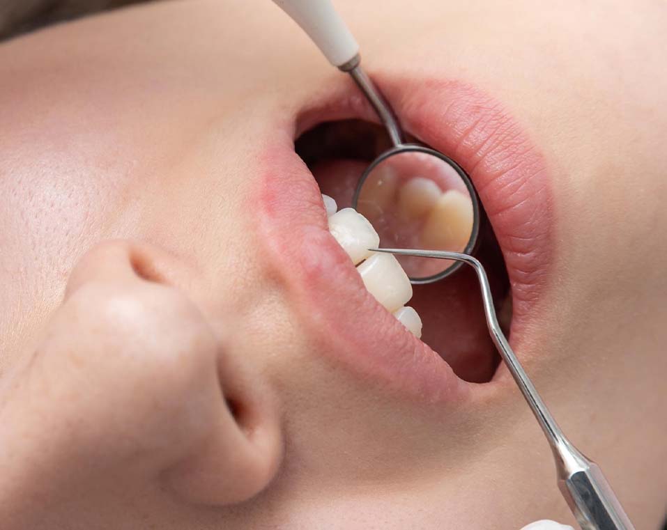 otturazioni dentali a prezzi accessibili in Albania
