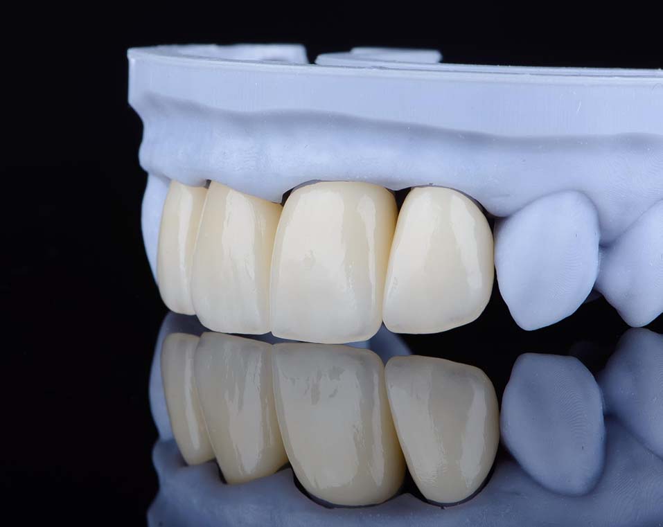 protesi dentarie a prezzi accessibili in Albania