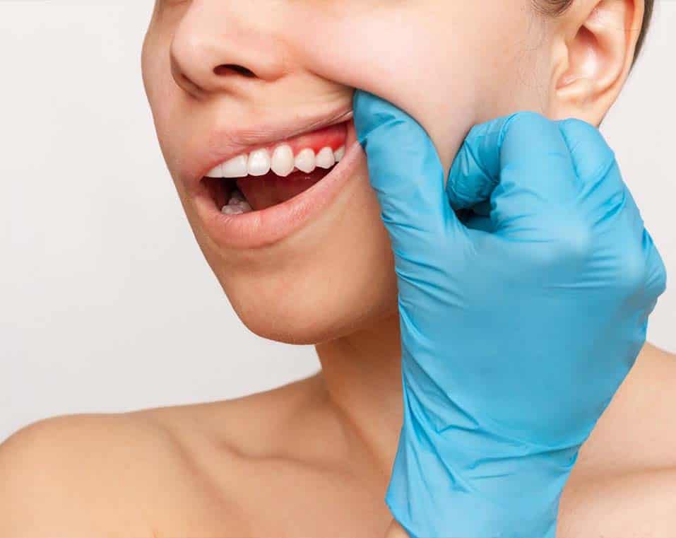 ascensore per le gengive a prezzi accessibili in Albania