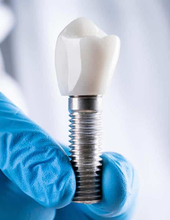 implantologia a prezzi accessibili in Albania