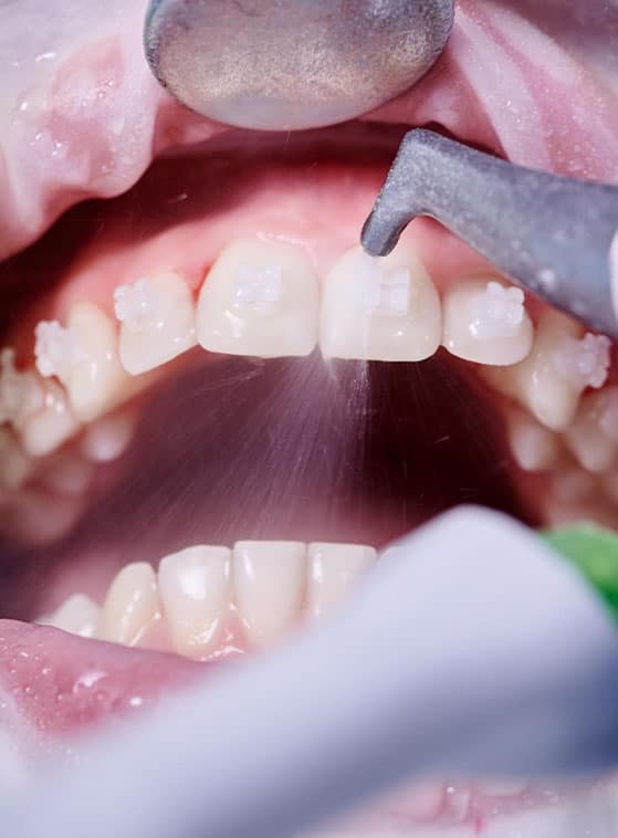 apparecchio ortodontico invisibile a prezzi accessibili in Albania