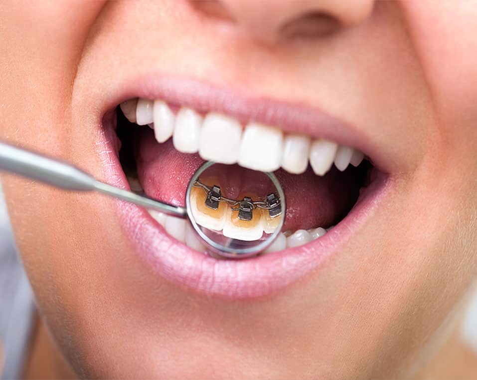 apparecchio ortodontico linguale a prezzi accessibili in Albania