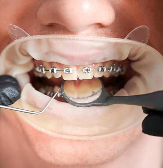 trattamenti ortodontici a prezzi accessibili in Albania