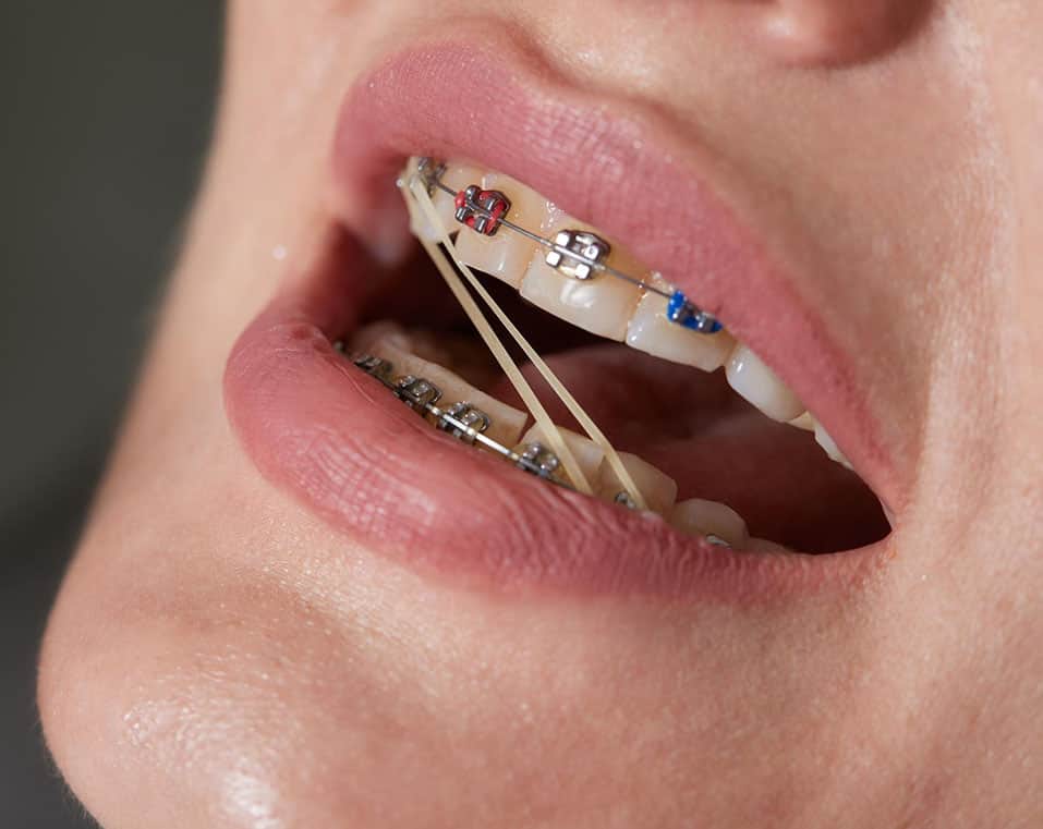 ortodonzia a prezzi accessibili in Albania