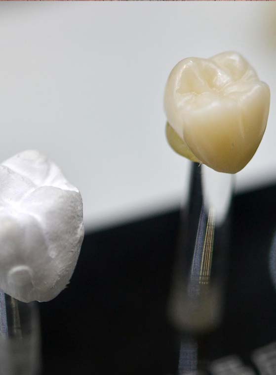 restauro dei denti a prezzi accessibili con protesi dentarie in Albania