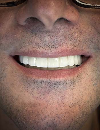 Rezultate të mahnitshme të implanteve dentare në Shqipëri