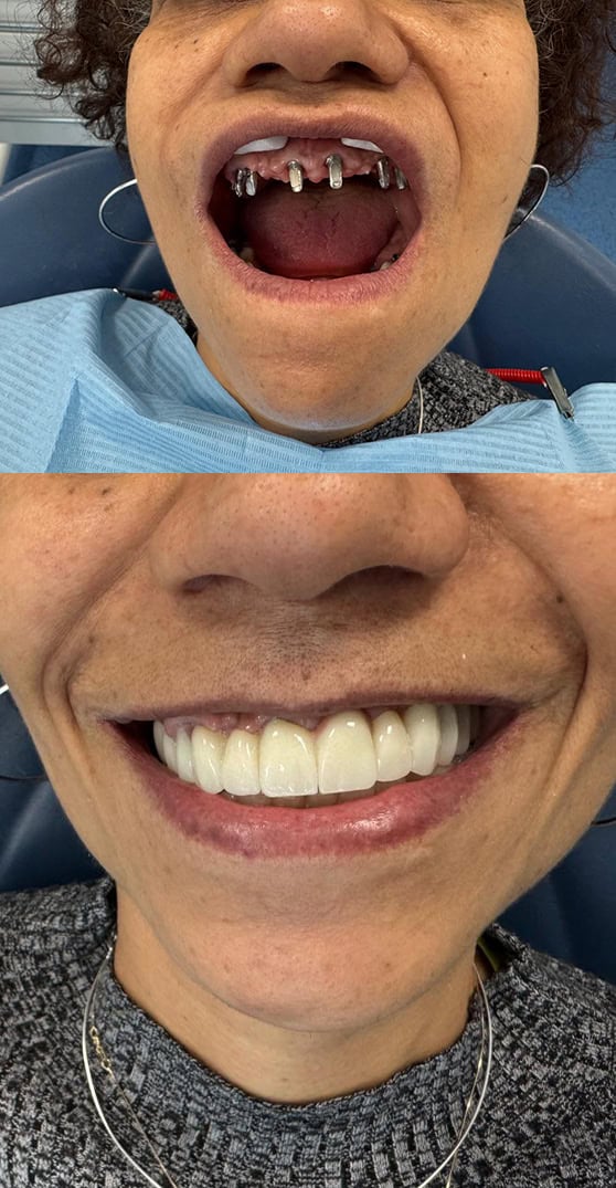 Restaurim i plotë mahnitës i harkut të dhëmbëve me 6 implante në Shqipëri