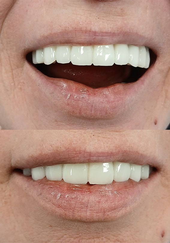 rezultate të mahnitshme në fund të fundit në 4 implante në Shqipëri