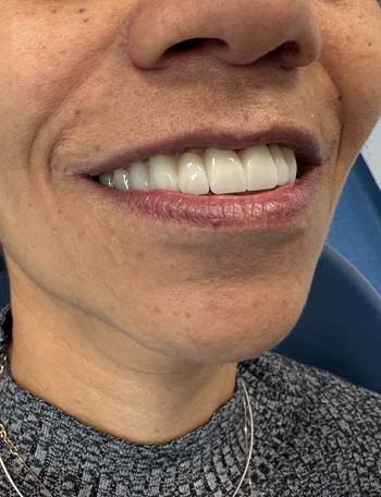 rezultate të mahnitshme në fund të fundit në 6 implante në Shqipëri