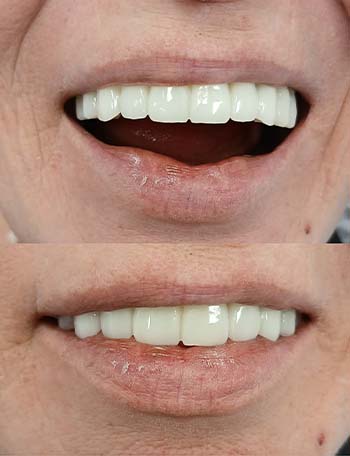 Rezultate të mahnitshme pas implanteve dentare në Shqipëri