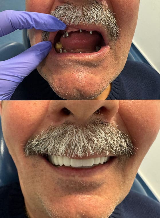 Rezultate të mahnitshme para dhe pas vendosjes së 6 implanteve në Shqipëri