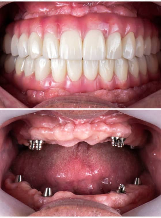 Rezultate të mahnitshme para dhe pas implanteve dentare në Shqipëri