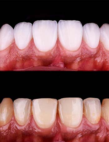 rezultate të mahnitshme me kurora dentare në Shqipëri