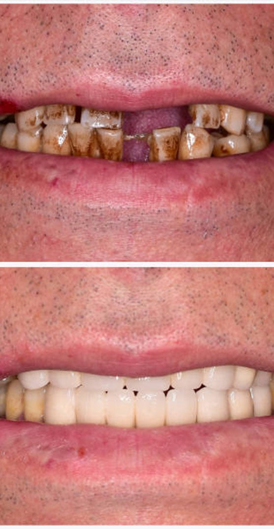 Rezultate të mahnitshme të zëvendësimit të dhëmbëve me implante dentare në Shqipëri