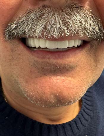 Transformim i mahnitshëm i zëvendësimit të dhëmbëve me implante dentare në Shqipëri