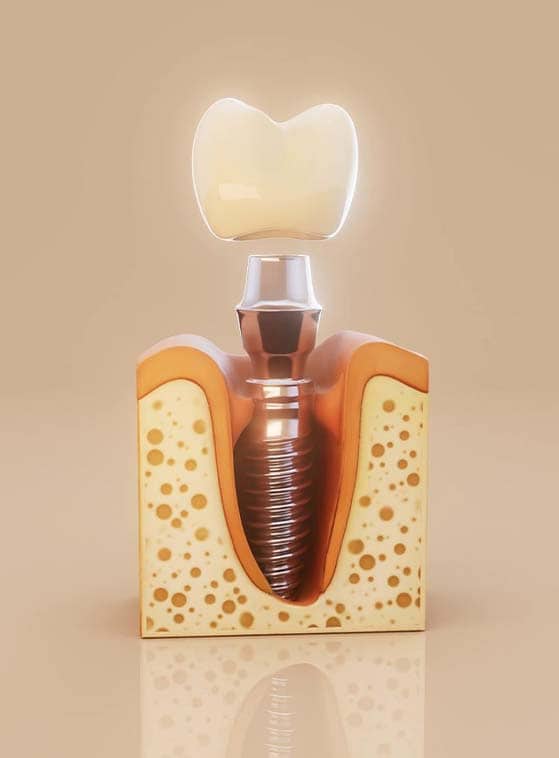 Impianti dentali in 48 ore