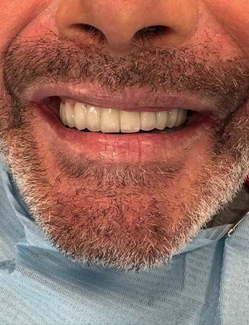 implantet dentare në Shqipëri rezultatet