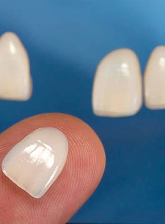 faseta dentare në Shqipëri