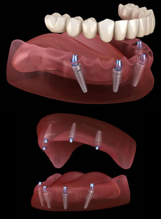 Zëvendësim i plotë i harkut të dhëmbit me implante all-on 4 në Shqipëri