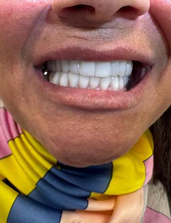 Restaurim i plotë i harkut dentar me implante dentare në Shqipëri