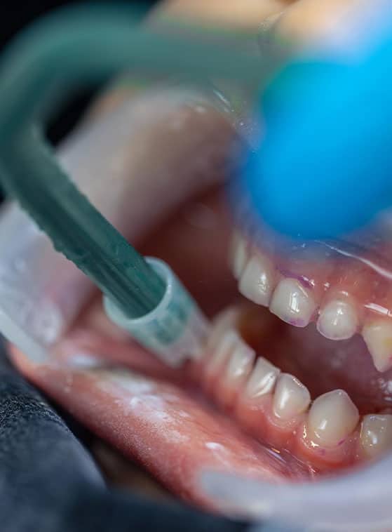 trattamento delle gengive in Albania