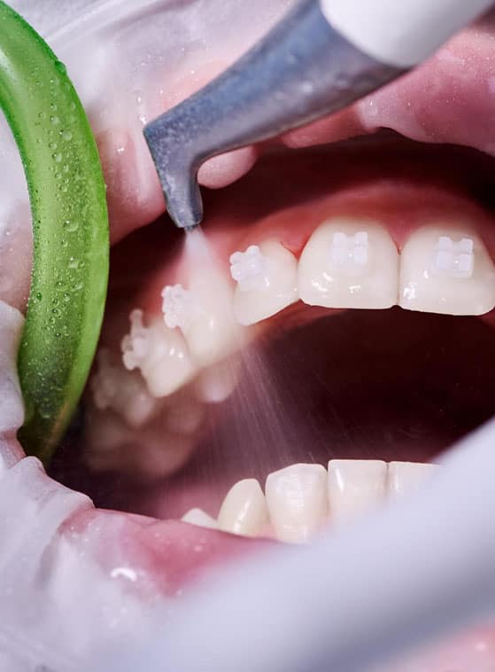 apparecchio ortodontico invisibile in Albania