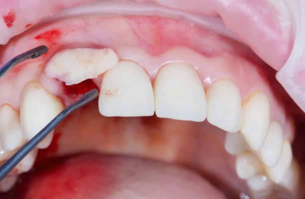 Aumento dei tessuti molli e innesto osseo prima degli impianti dentali in Albania