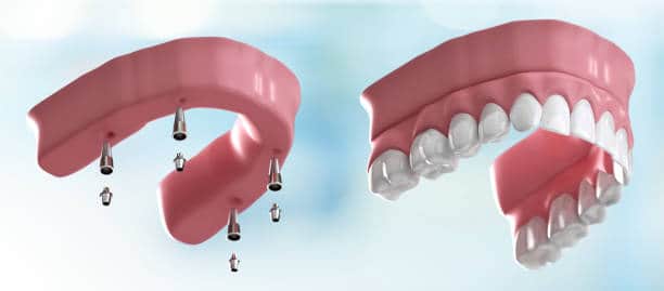 implante të avancuara all-on 4 në Shqipëri për zëvendësim të plotë të harkut të dhëmbit 