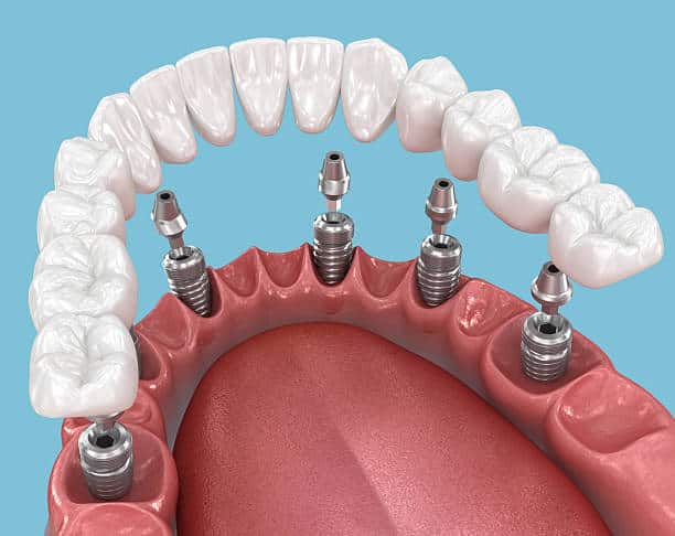 Zëvendësim i avancuar i dhëmbëve me implante all-on 6 në Shqipëri