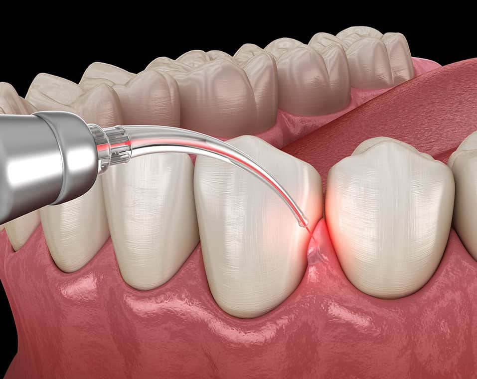 odontoiatria laser in Albania