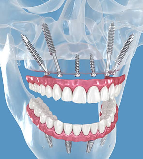 implantet pterigoide në Shqipëri për pacientët me humbje të kockave