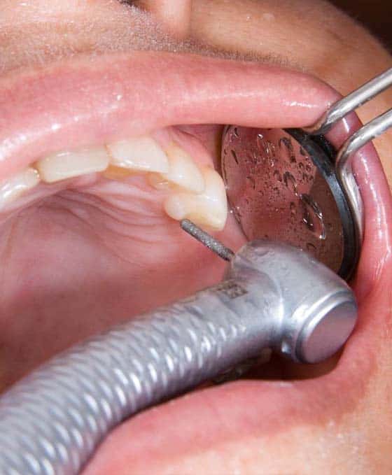 otturazioni dentali di qualità in Albania