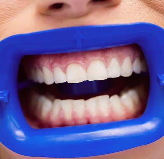 odontoiatria estetica sicura in Albania