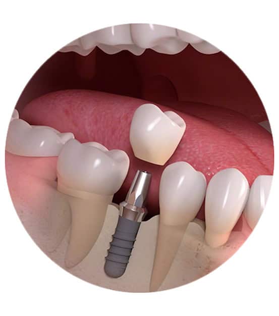 impianti dentali in giornata in Albania