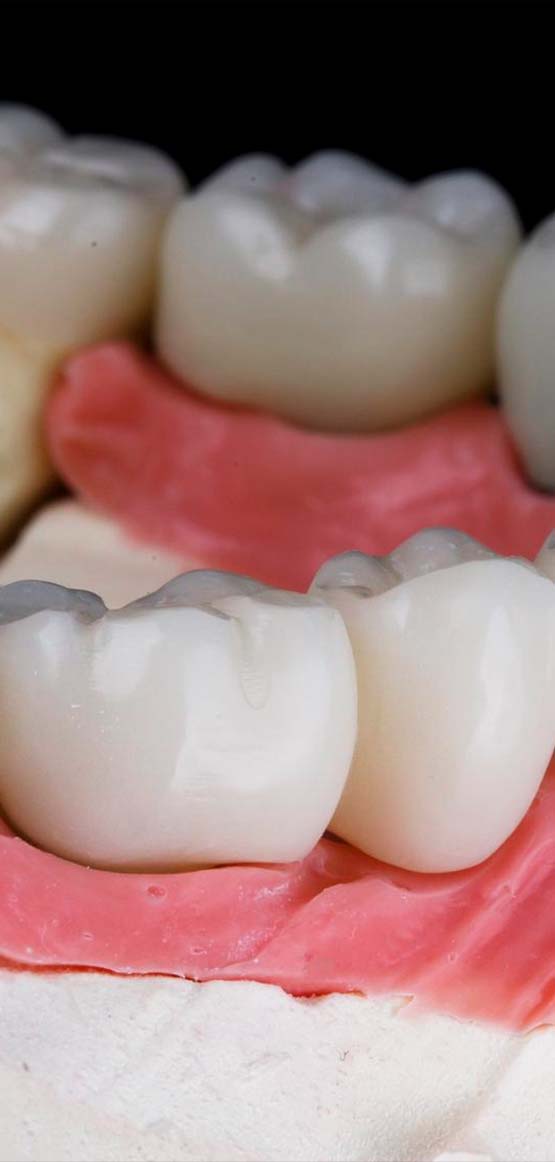 sostituzione dei denti con ponti dentali in Albania