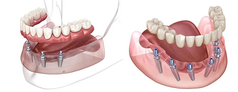All-on-4 vs All-on-6: Cila alternativë e implantit për harkun e plotë është më e mirë?