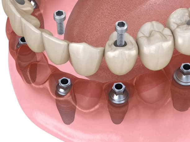 Implantet dentare All-on-4: Si katër implante mund të zëvendësojnë të gjitha dhëmbët tuaj