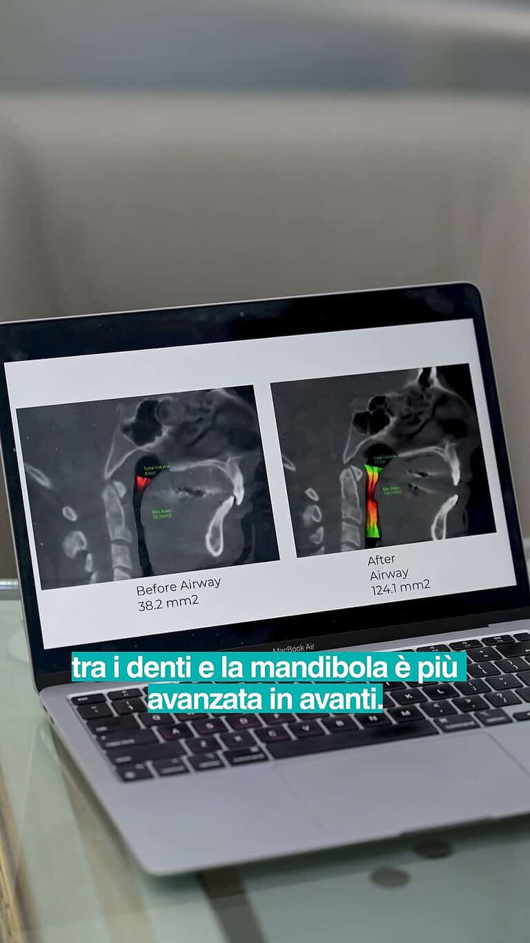 Përtej një buzëqeshjeje të bukur: Si inovacioni dentar po zgjidh apene e gjumit