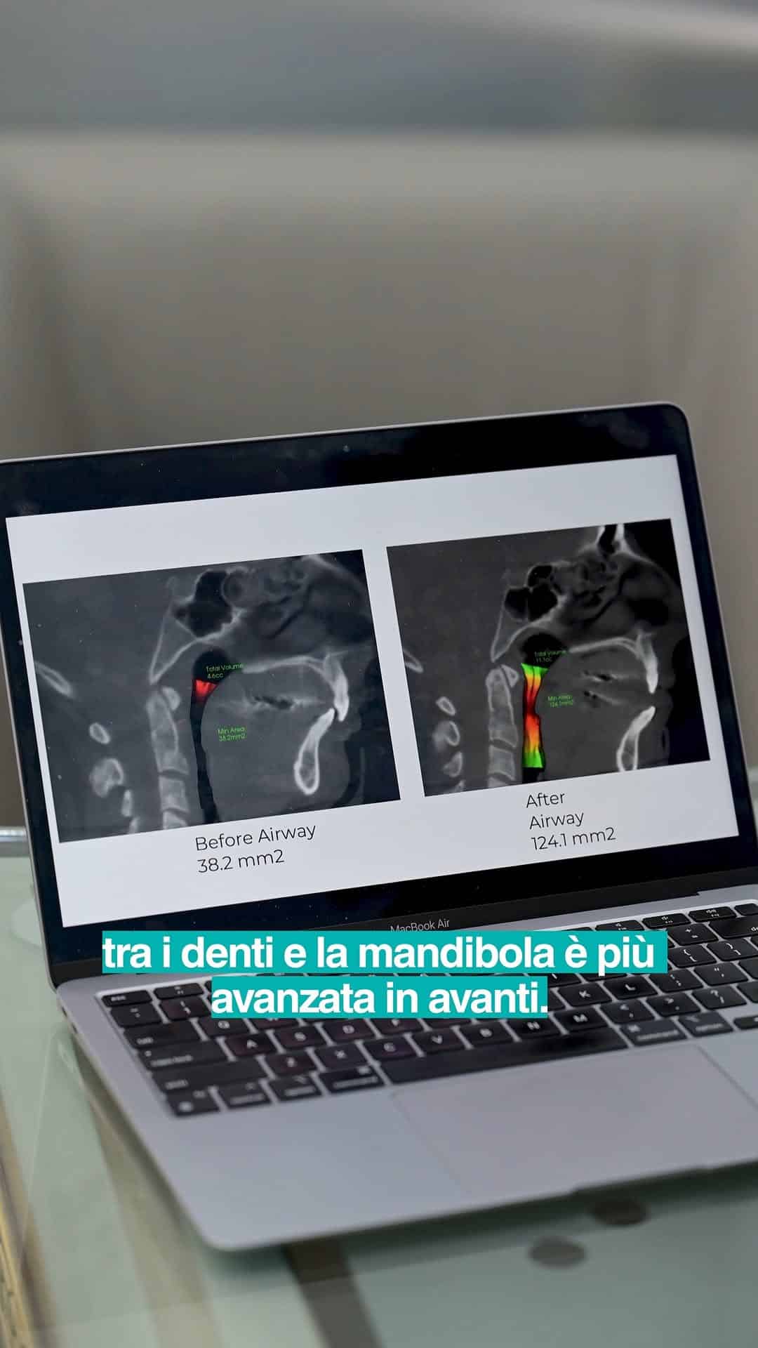 Para dhe pas CT skaner të zgjerimit të rrugëve ajrore për apene gjumi në Spitalin Amerikan Dental.